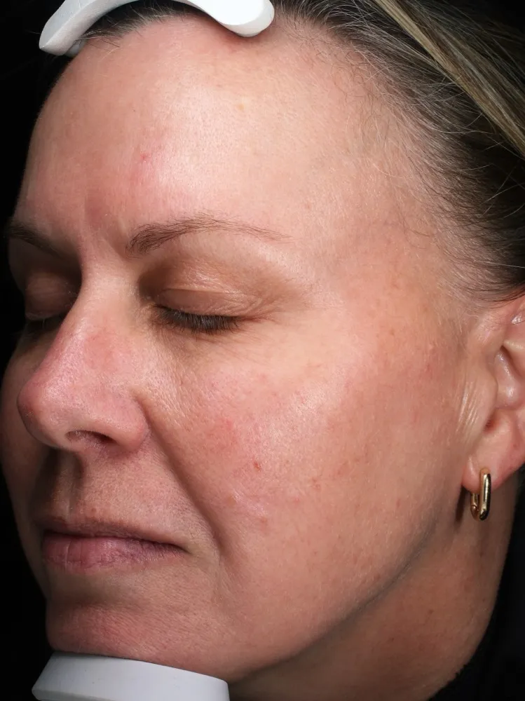 Amanda - After 1 Laser Genesis treatment