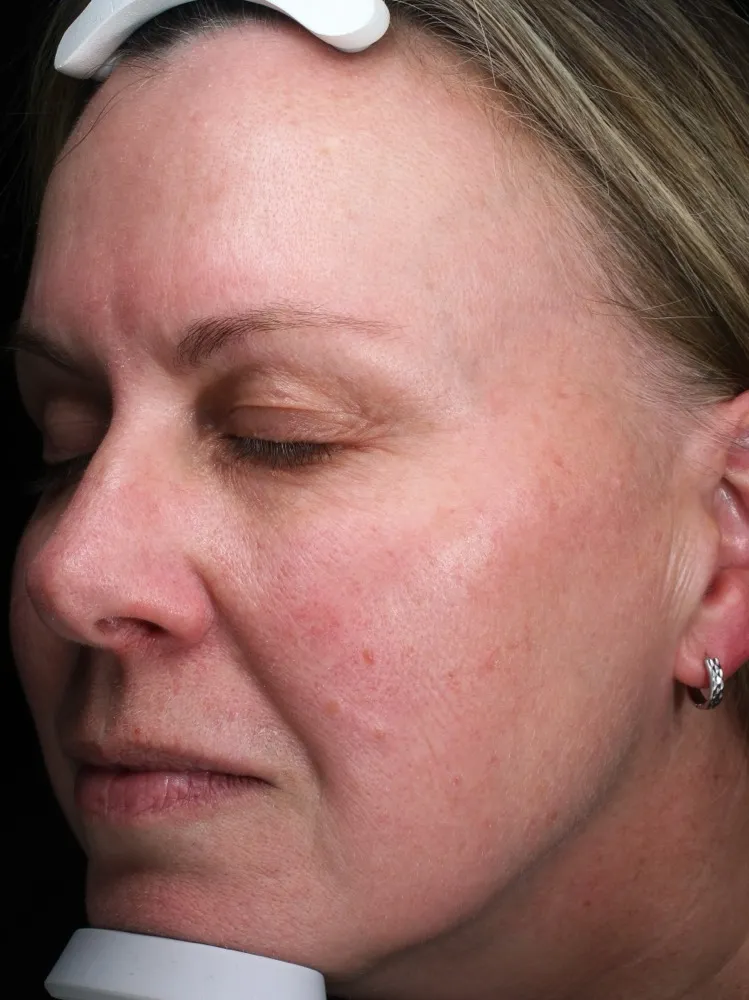 Amanda - Before 1 Laser Genesis treatment