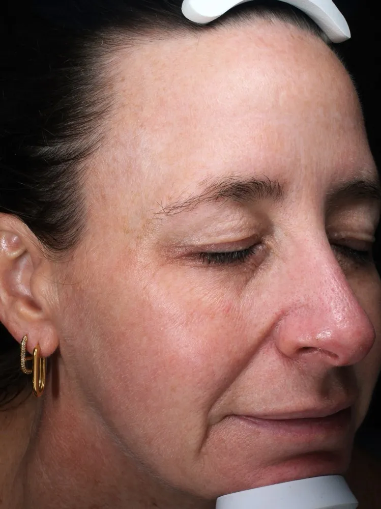 Caroline - After 3 Laser Genesis treatments