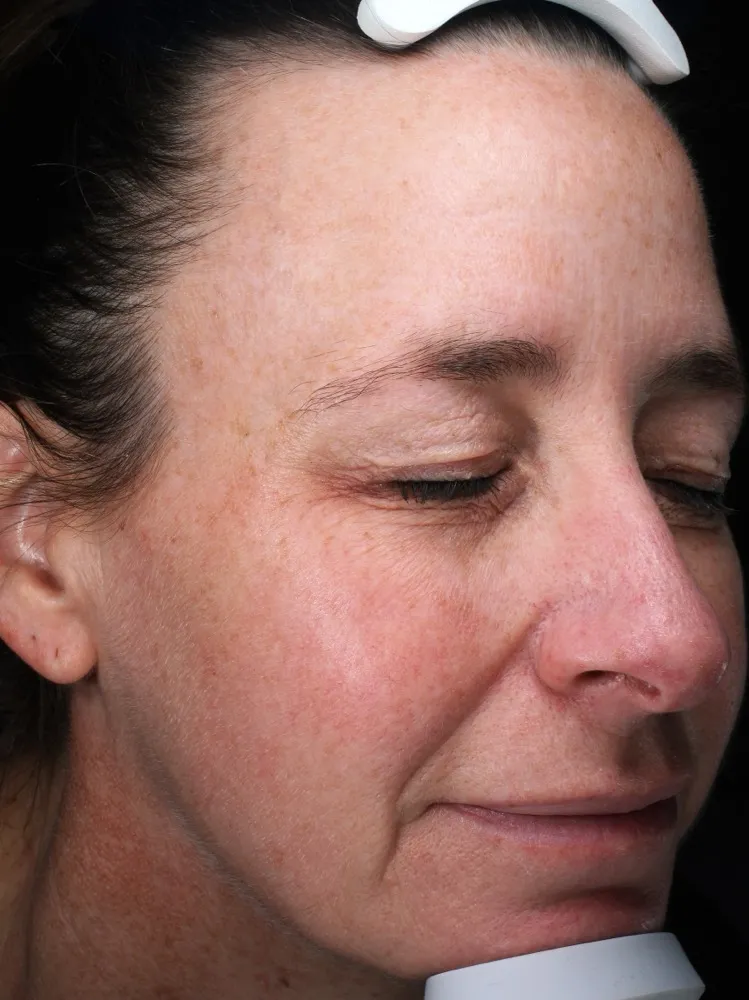 Caroline - Before 3 Laser Genesis treatments