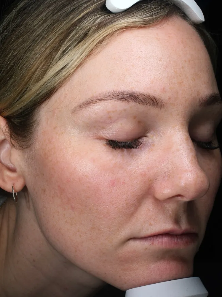 Sarah - After 3 Laser Genesis treatments