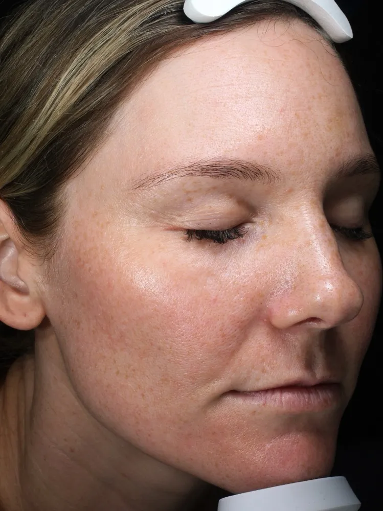 Sarah - Before 3 Laser Genesis treatments
