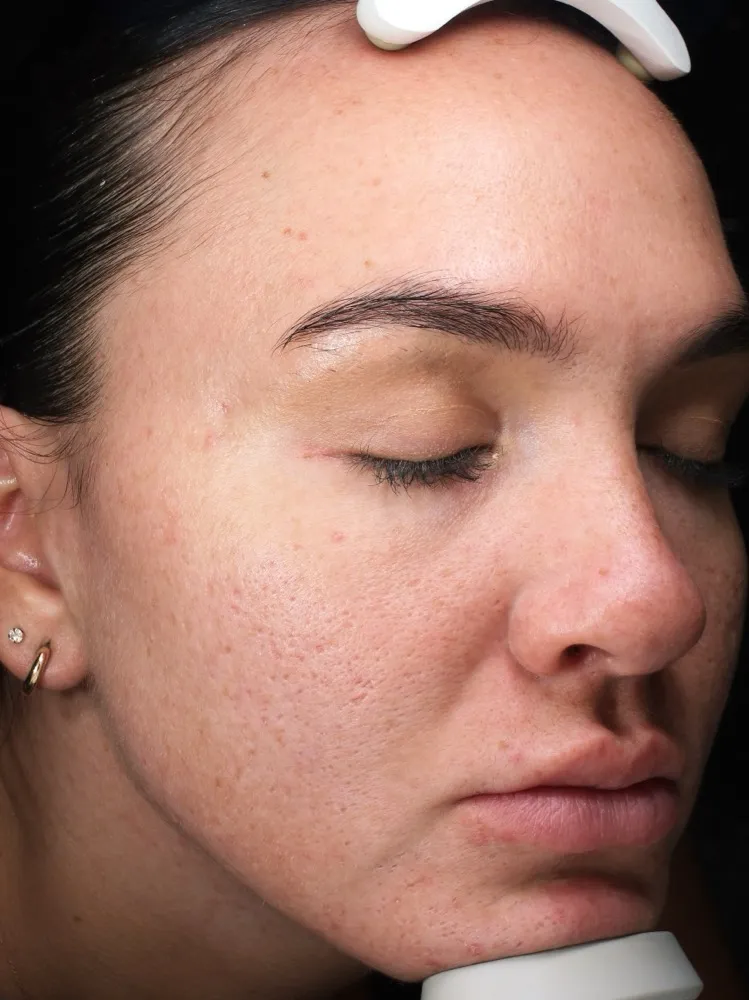 Yana - After 6 Laser Genesis treatments