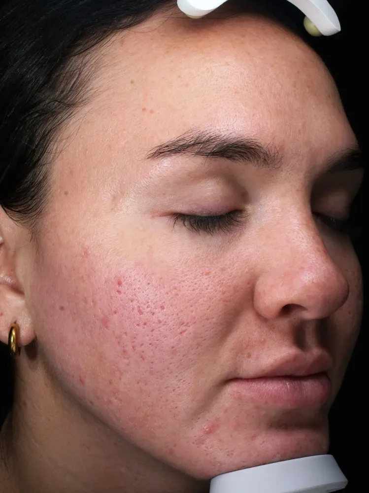 Yana - Before 6 Laser Genesis treatments