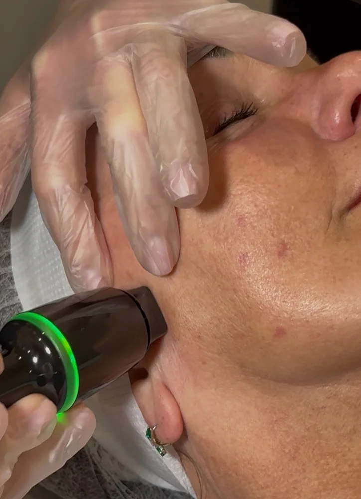 trilift-needling Trilift needling